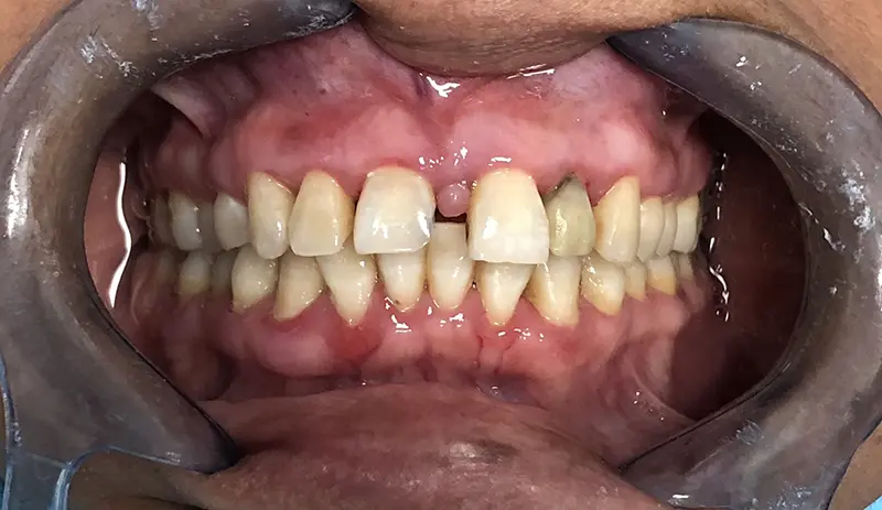 Dental Bridge Cases 1